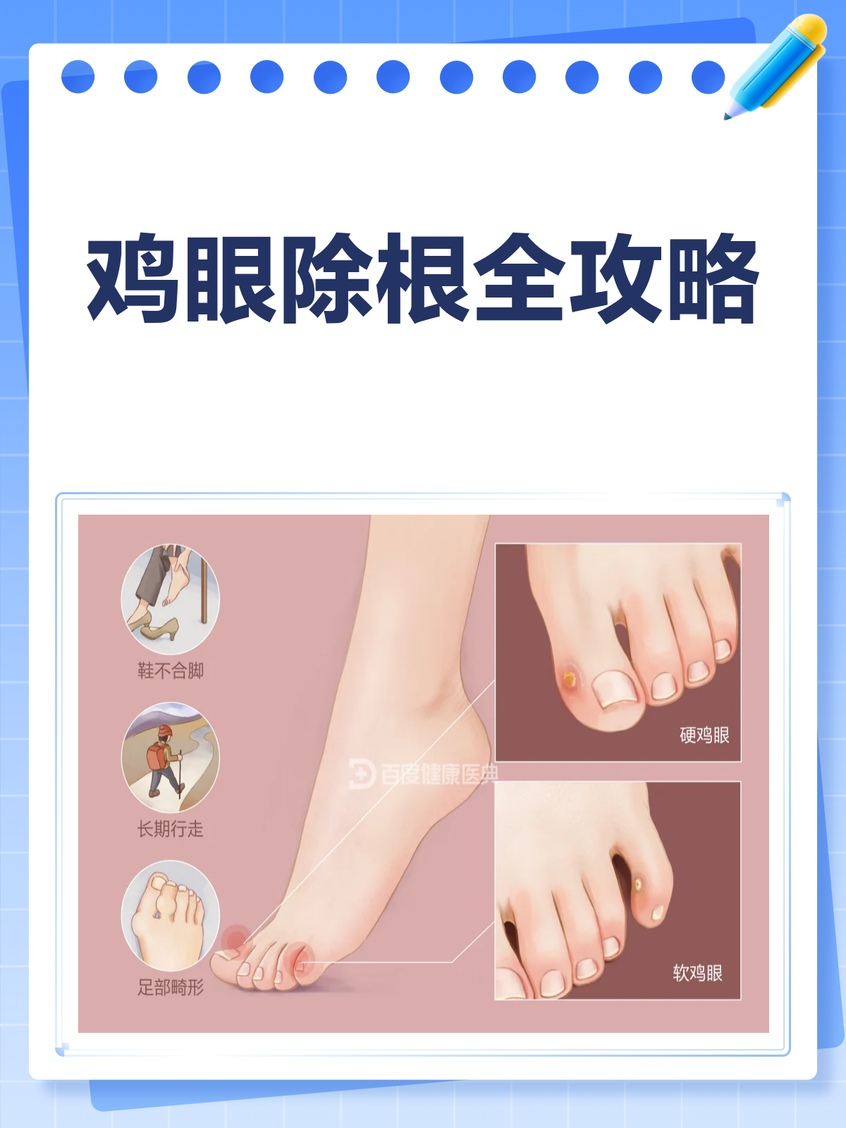 鸡眼烦恼别再有！彻底除根方法大揭秘