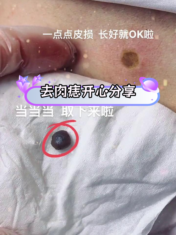 终于去除大肉痣,心情超好