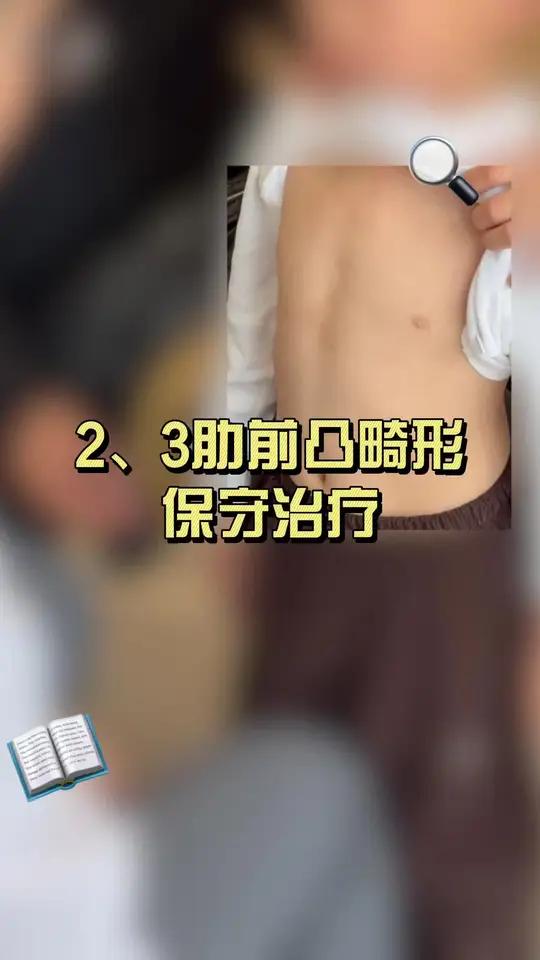 2、3 肋前突畸形的保守治疗 #鸡胸 #肋骨外翻 #漏斗胸 #健康科普破圈计划 #抖出健康