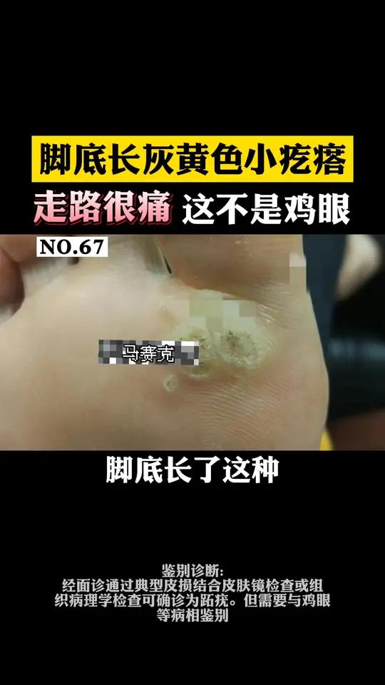 脚底长这种灰黄色的小疙瘩,这可不是鸡眼,可能是跖疣,试试这样做!