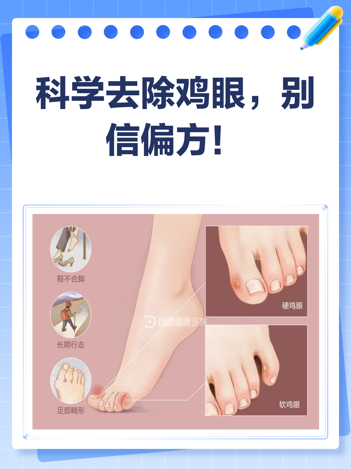 鸡眼去除别信偏方!科学治疗才是王道