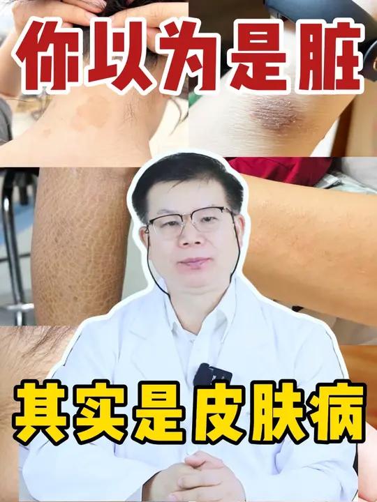 这可不是洗澡没洗干净，而是皮肤病，可别大意