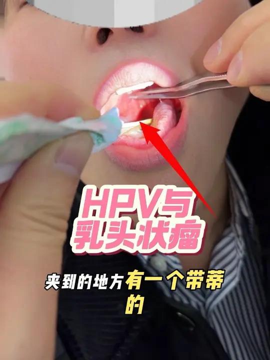 HPV还会长在喉咙里!喉咙里长瘤不疼不痒?HPV还会长在喉咙里!这种咽喉肿瘤夫妻都要查#乳
