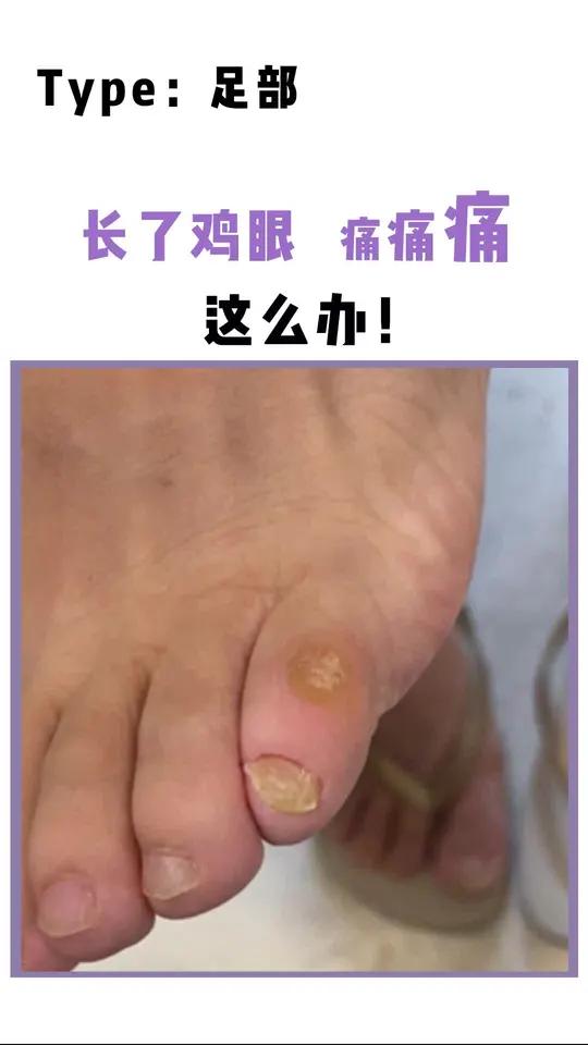 走路脚底非常痛,有可能你是长了鸡眼,这样做~