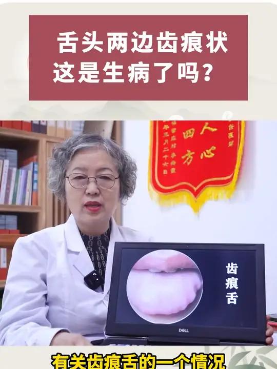 舌头两边有齿轮状的痕迹,这种舌象代表了什么?今天来跟大家讲解一下