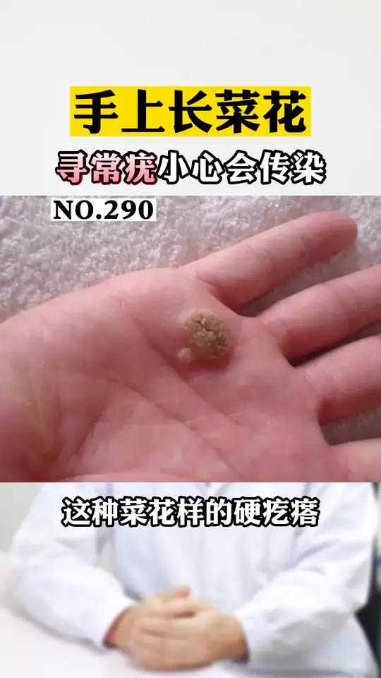 手上长菜花样小肉粒,小心会传染,可以试试这样处理