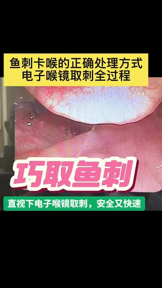 鱼刺卡喉的正确处理方式：电子喉镜取刺全过程 鱼刺卡喉别再乱来！直视下电子喉镜取刺，安全又快