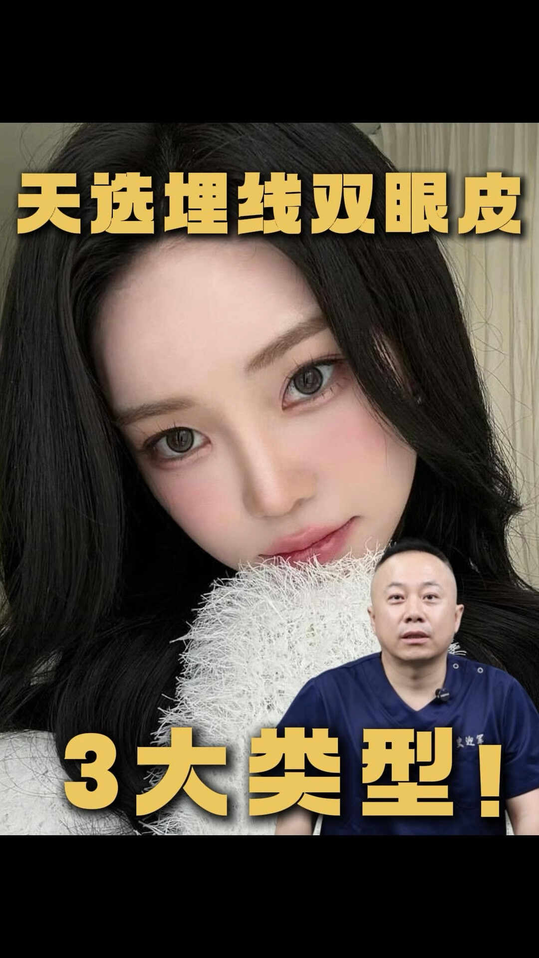 天选埋线双眼皮的三大类型介绍#健康养生# #养生# #医美#