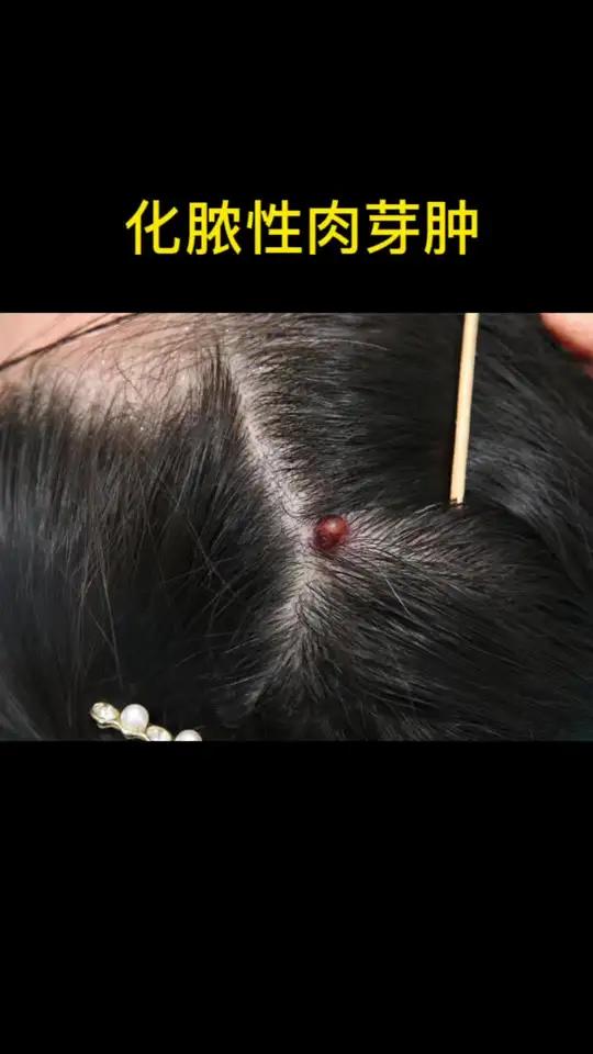头发长了红色肉芽,化脓性肉芽肿要与皮肤血管瘤、皮肤纤维瘤等鉴别诊断