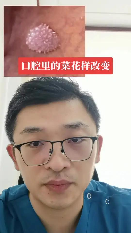 口腔里的菜花样改变