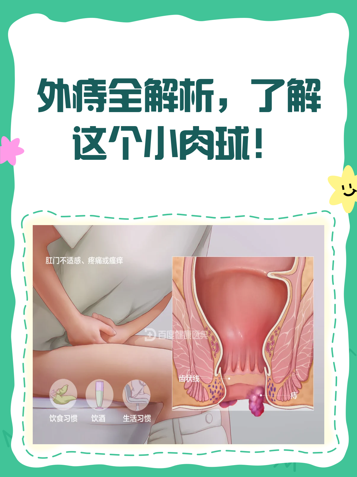 外痔知多少?一文带你认清这个“小肉球”