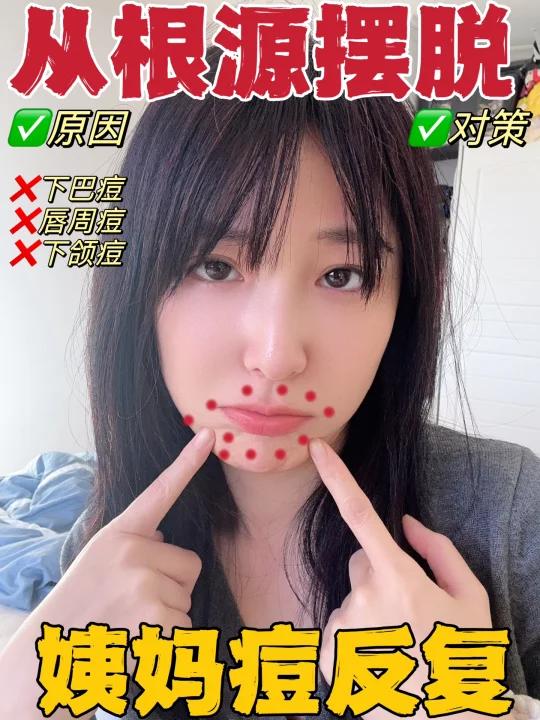 从根源摆脱反复长姨妈痘下巴唇周下颌痘