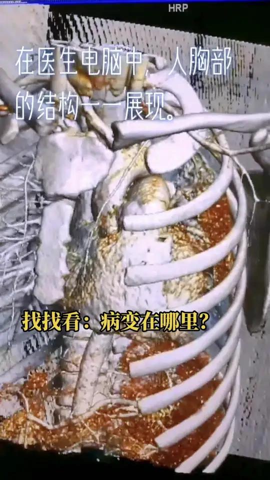 胸部肿块 肺部结节肺癌CT解剖找找看:病变在哪里?