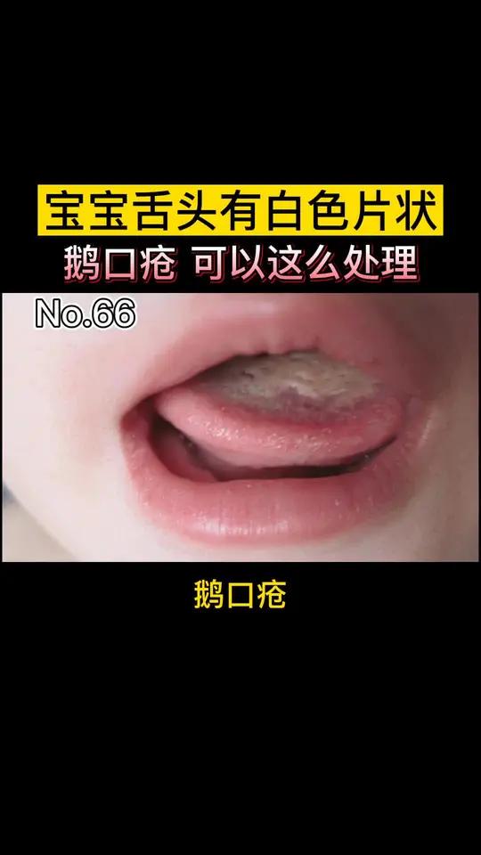宝宝鹅口疮,可以这么办