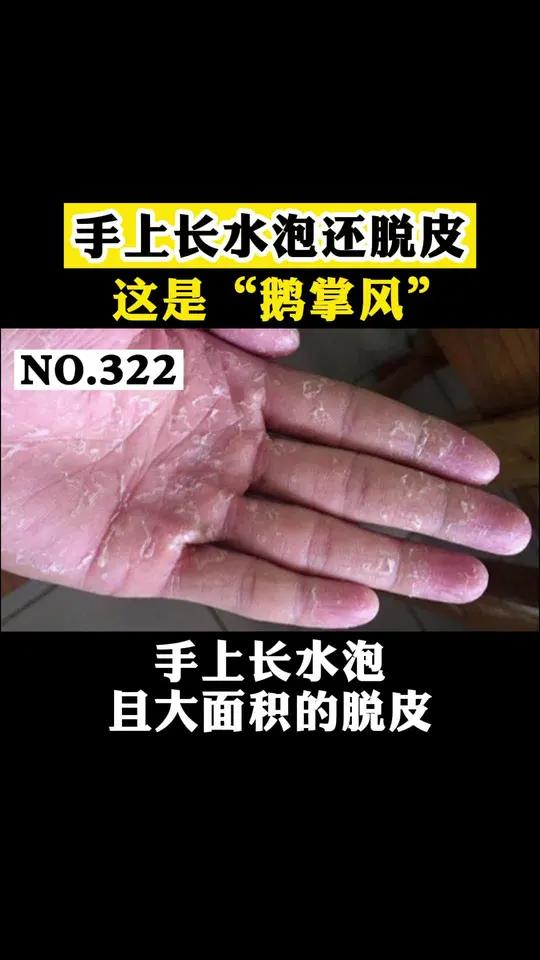 手上长水泡还大面积脱皮,非常痒,这是鹅掌风!试试这样处理