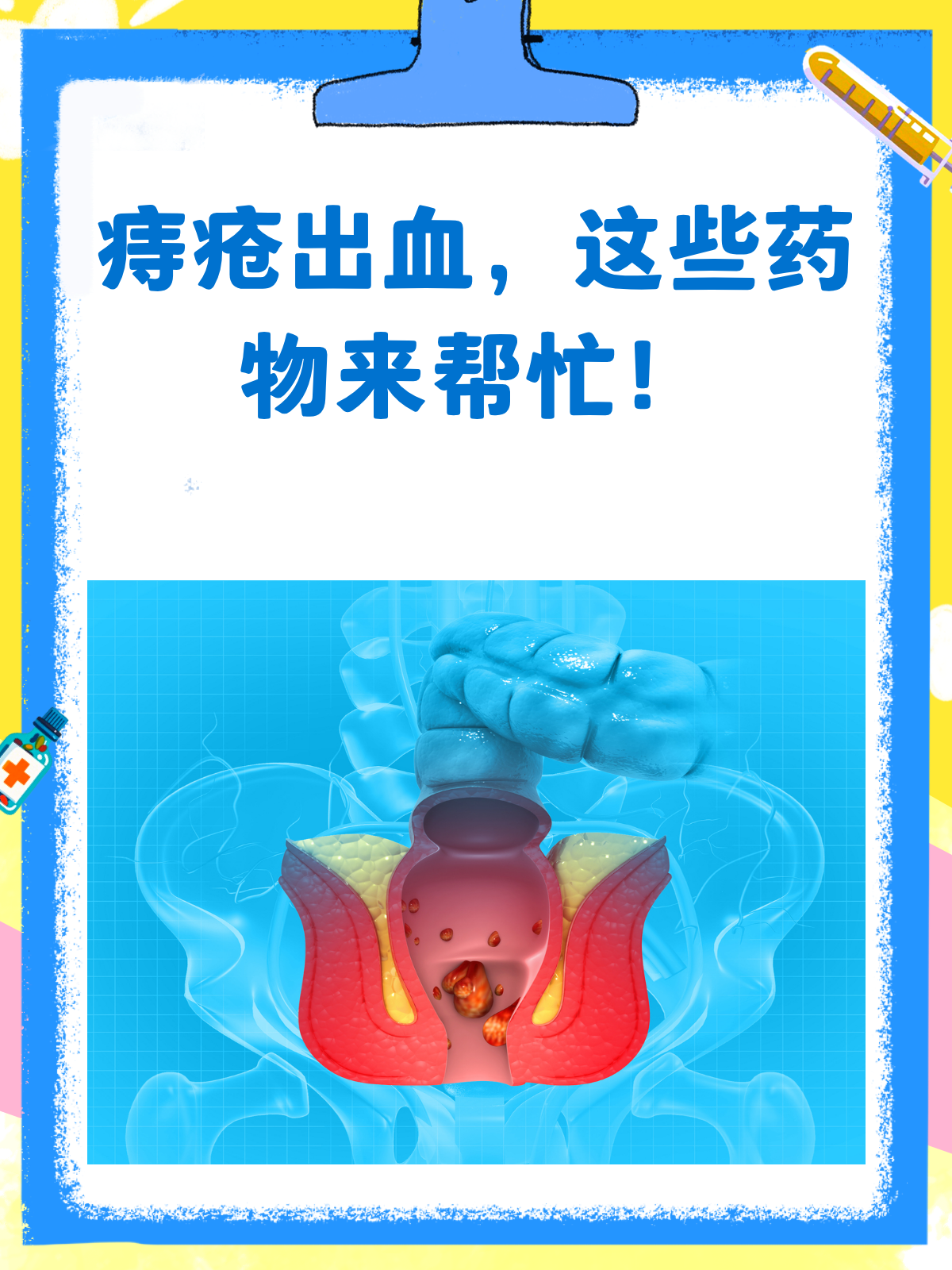 痔疮出血怎么办?药物攻略来帮忙!