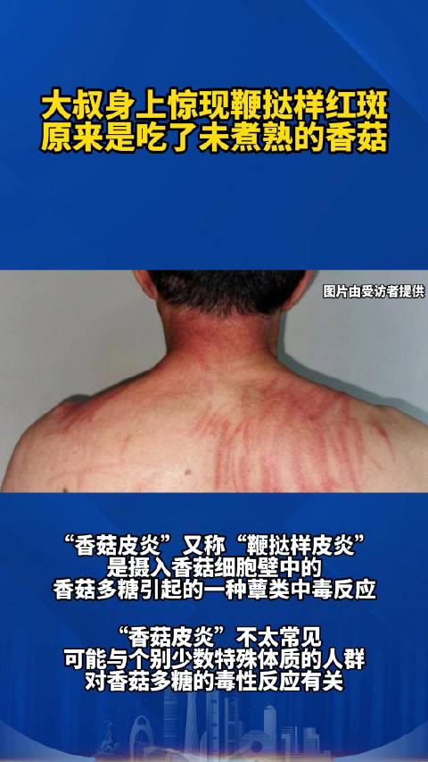 「男子吃未熟香菇身现鞭打样红斑 医生:典型的“香菇皮炎”」日前在广州,一位阿叔发现自己身上