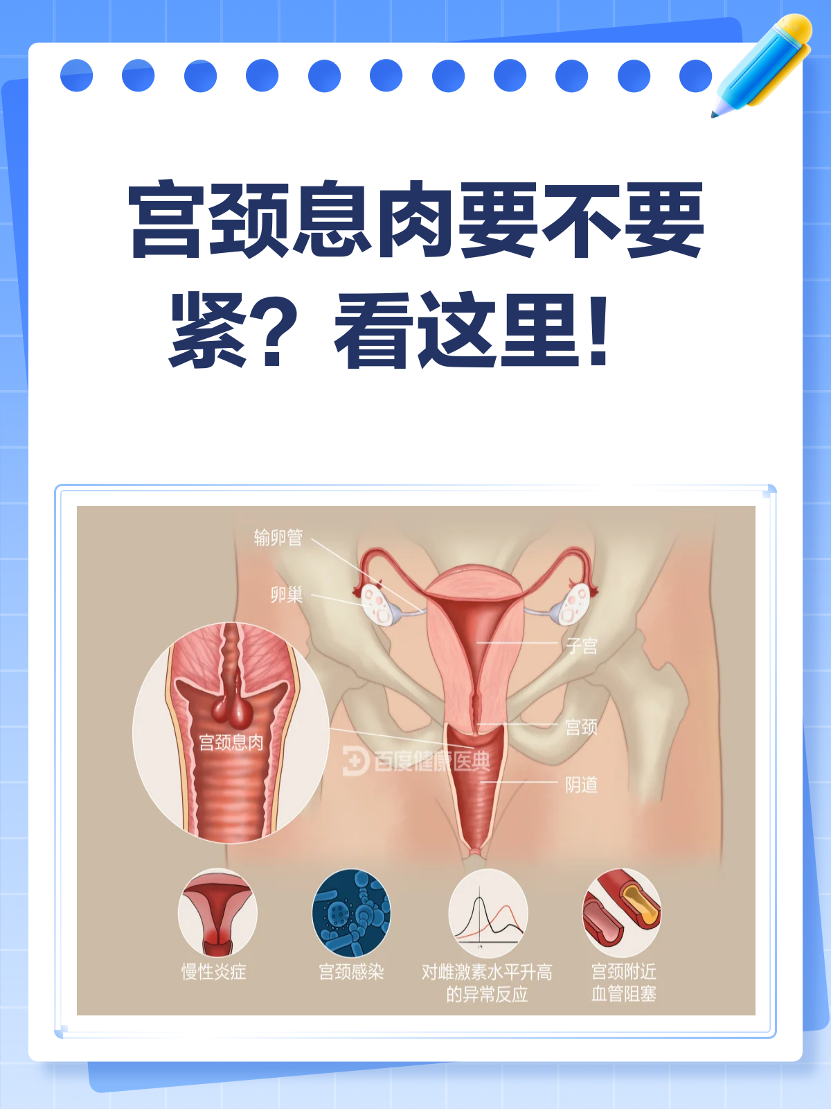 宫颈息肉,别慌!一文告诉你要不要紧