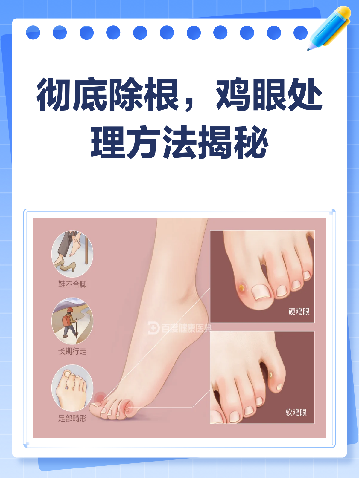 鸡眼烦恼？来看这份彻底除根攻略