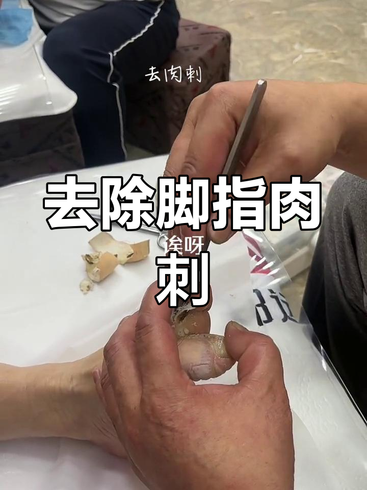 脚指肉刺软化处理