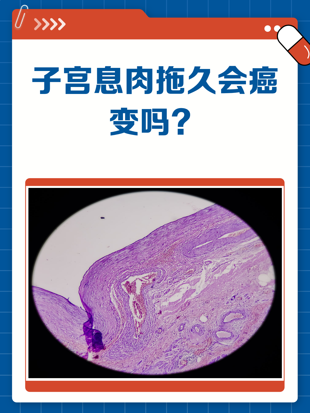 子宫息肉拖久了,真的会癌变吗?