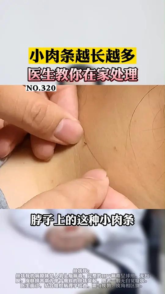 身上长了小肉粒,别剪,会越长越多!丝状疣这样处理