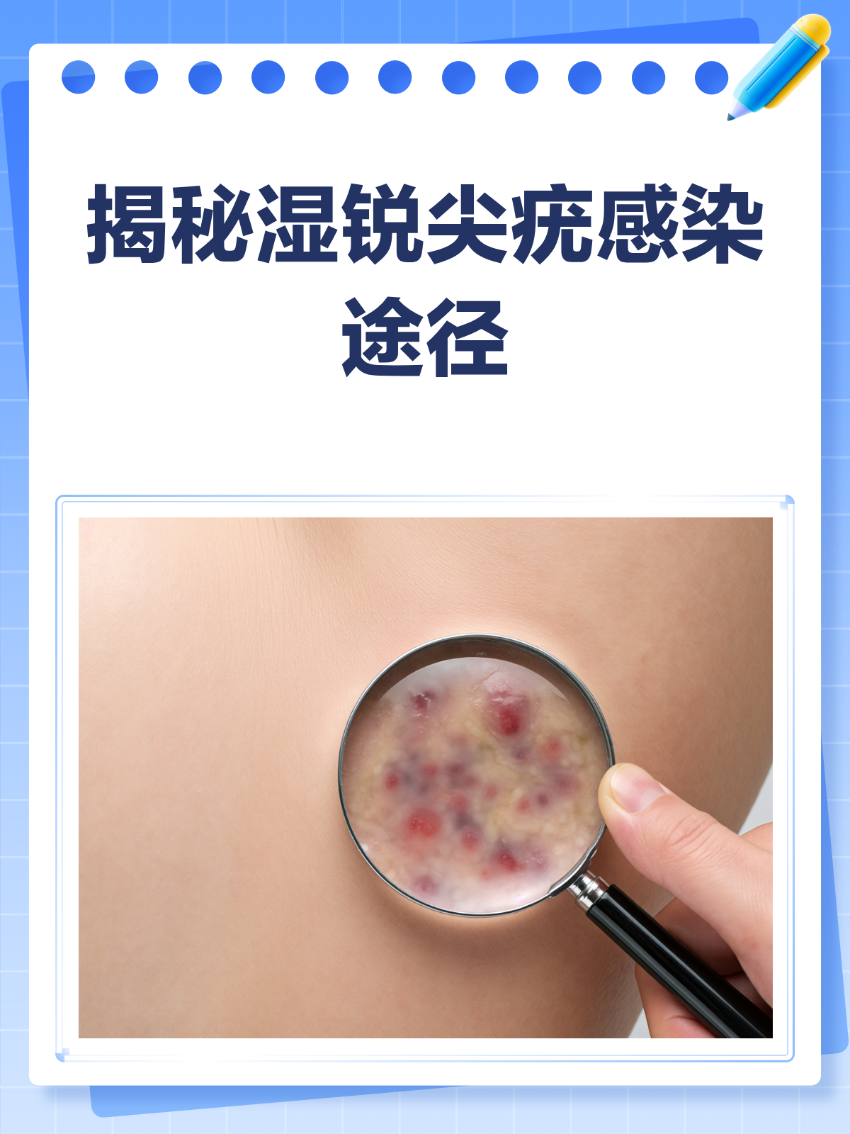 揭秘!湿锐尖疣,这些途径让你“中招”!