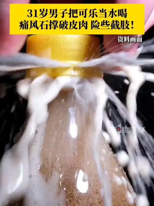 广州的吴先生日常喝3罐可乐,全身关节长满通风石,但未引起重视。近日,他的右脚脚趾头骨在痛风