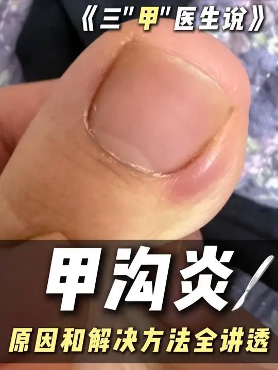 折磨人的甲沟炎,今天就把原因和解决方法一次性全讲透!#抖出健康知识宝藏 #华东医院陈亮 #