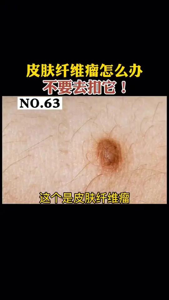 身上长皮肤纤维瘤,不要去扣它,那应该怎么办呢