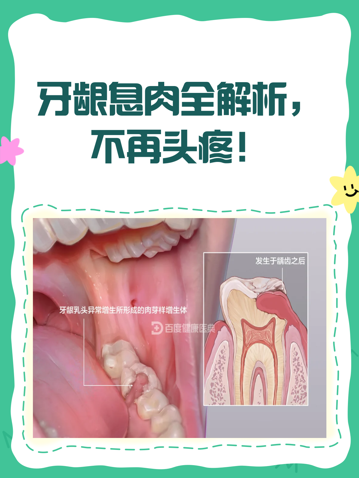 牙龈上的“不速之客”?揭秘牙龈息肉!
