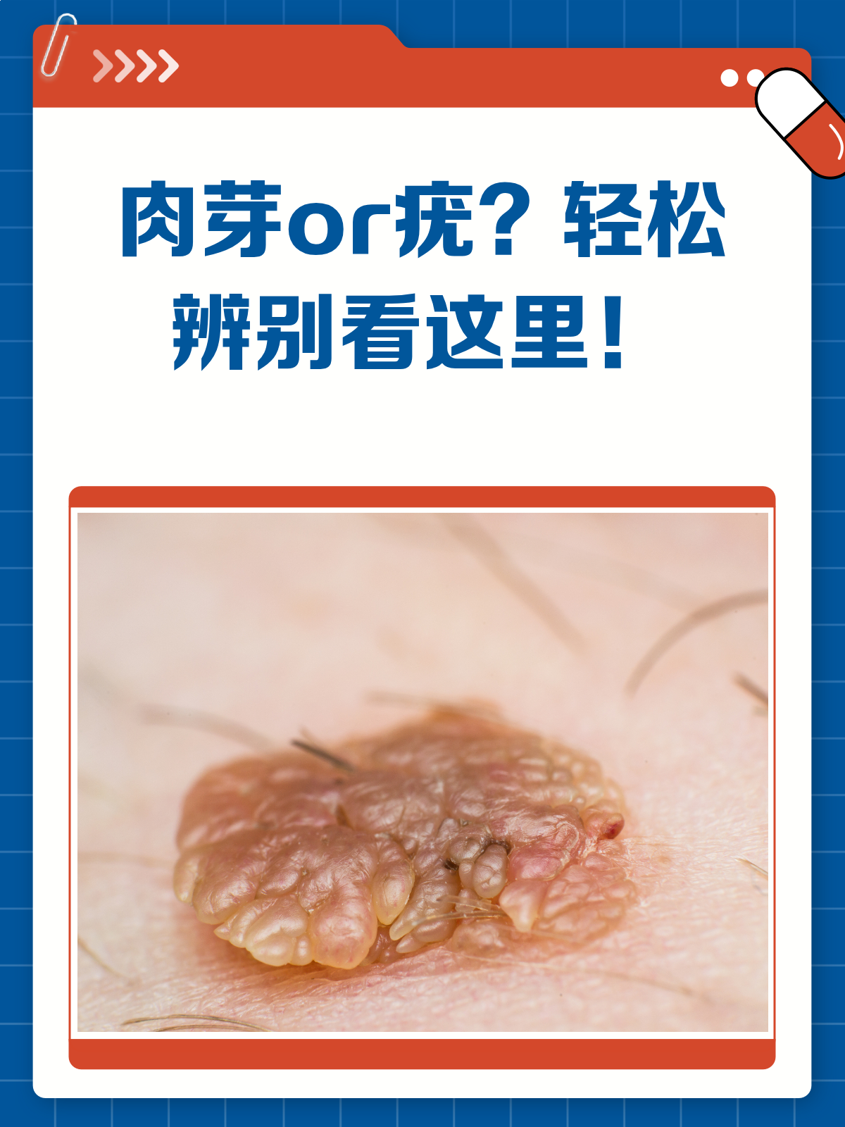 肉芽or疣？ 一文教你轻松辨别！