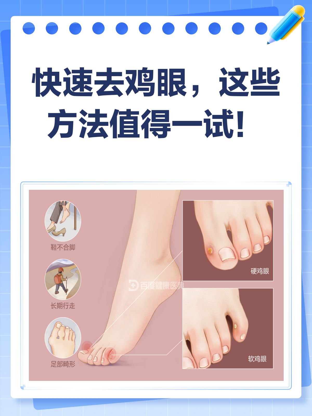 去鸡眼最快最好的方法？看这里就知道！