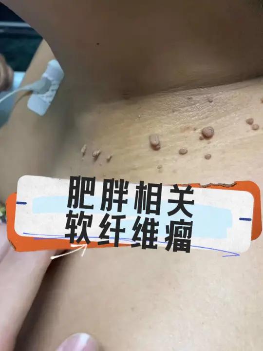 肥胖合并糖尿病患者好多人颈部、腋窝等处会长好多质软无弹性的赘生物,一般为软纤维瘤……