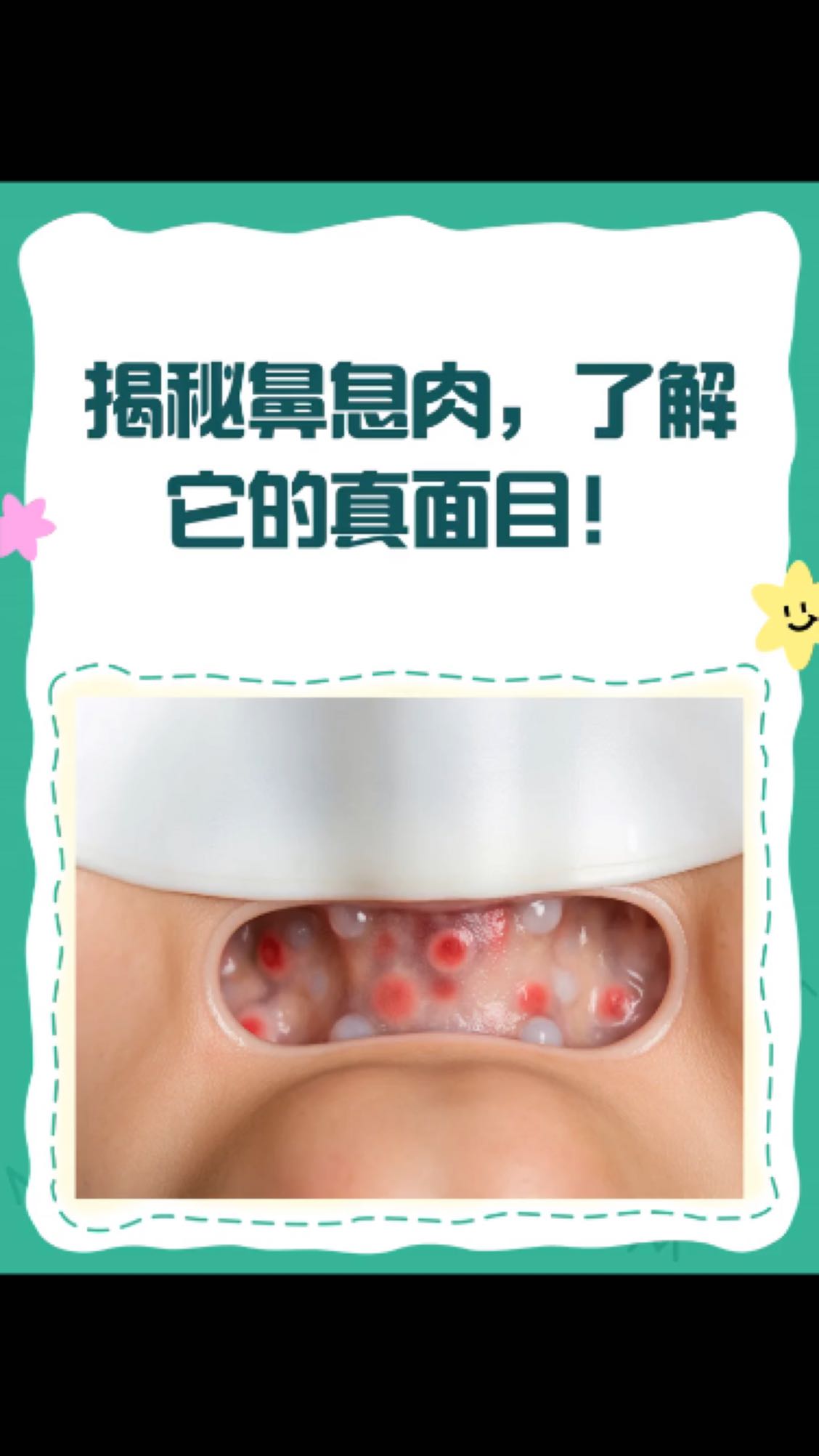 鼻息肉真面目揭秘!看图识病不迷茫~