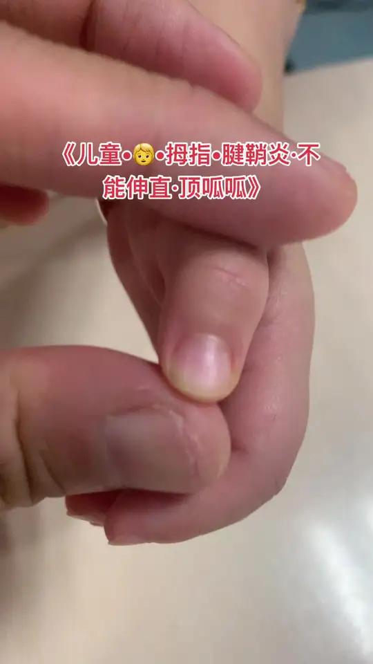 儿童大拇指腱鞘炎不能伸直 不能顶呱呱?1岁以下大多可以缓解,针对3岁以上长时间不能关节弯曲
