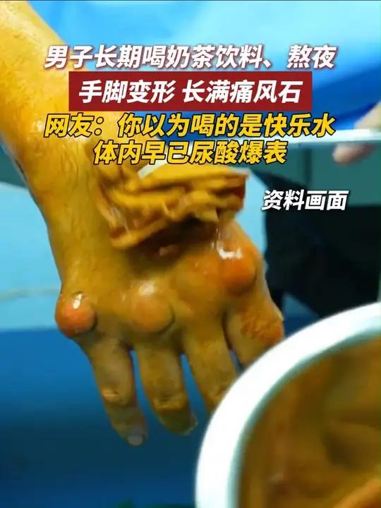 男子长期喝奶茶饮料、熬夜 手脚变形 长满痛风石 网友:你以为喝的是快乐水 体内早已尿酸爆表