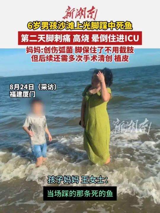 6岁男孩沙滩上光脚踩中死鱼第二天脚刺痛高烧晕倒住进 ICU。妈妈:“创伤弧菌,脚保住了不用
