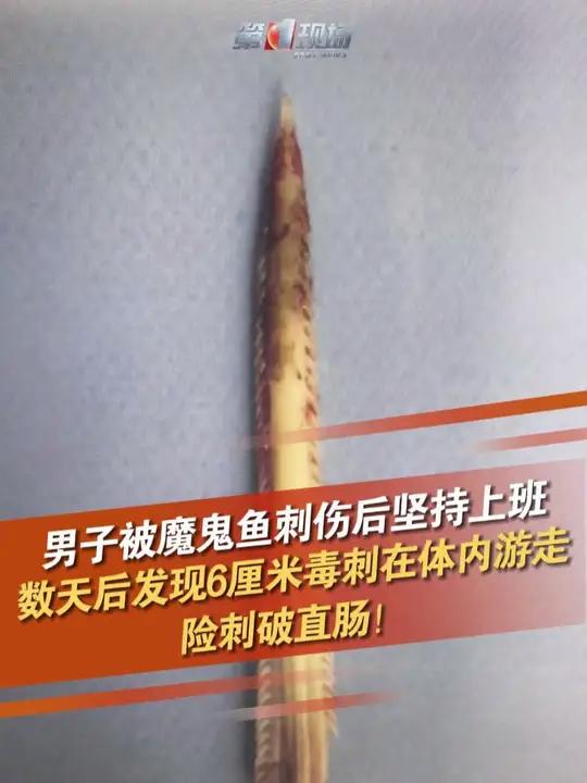 近日,广东深圳的小吴和朋友去惠州捕鱼,在宰杀“魔鬼鱼”时,小吴被一根弹起的毒刺扎进右腿,他