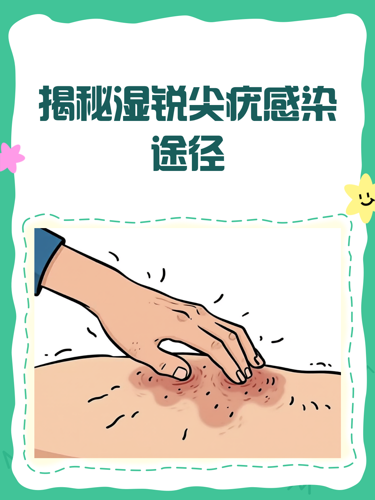 揭秘!湿锐尖疣,这些途径让你“中招”!