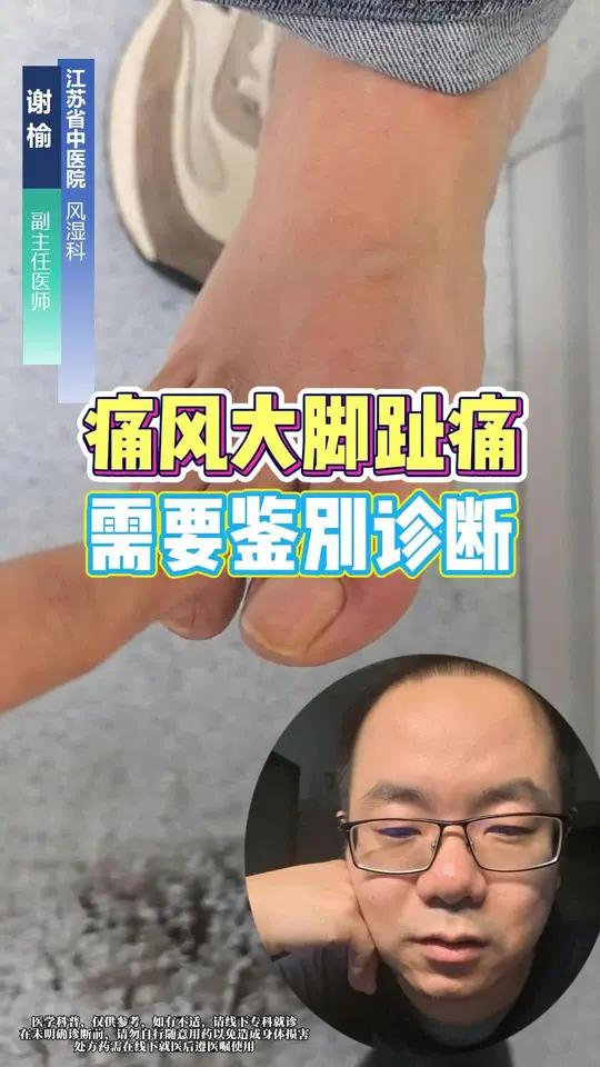 痛风大脚趾痛 需要鉴别诊断 痛风 硬核健康科普行动