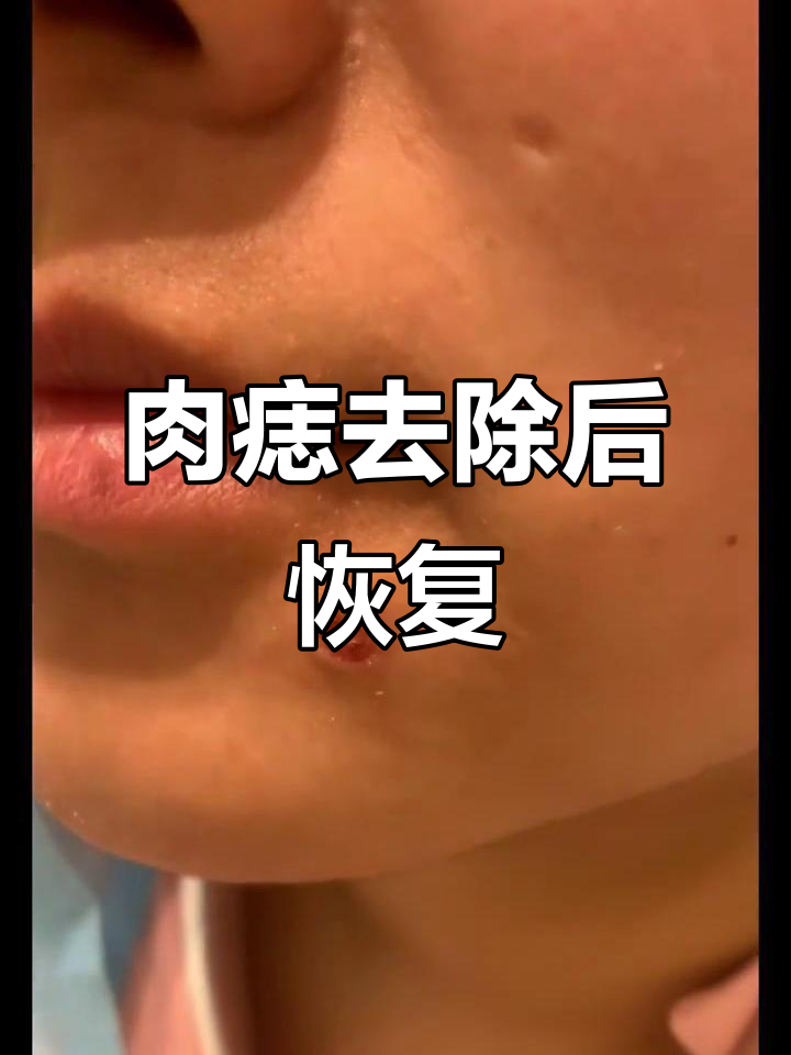 大肉痣祛除后的恢复过程,效果惊人