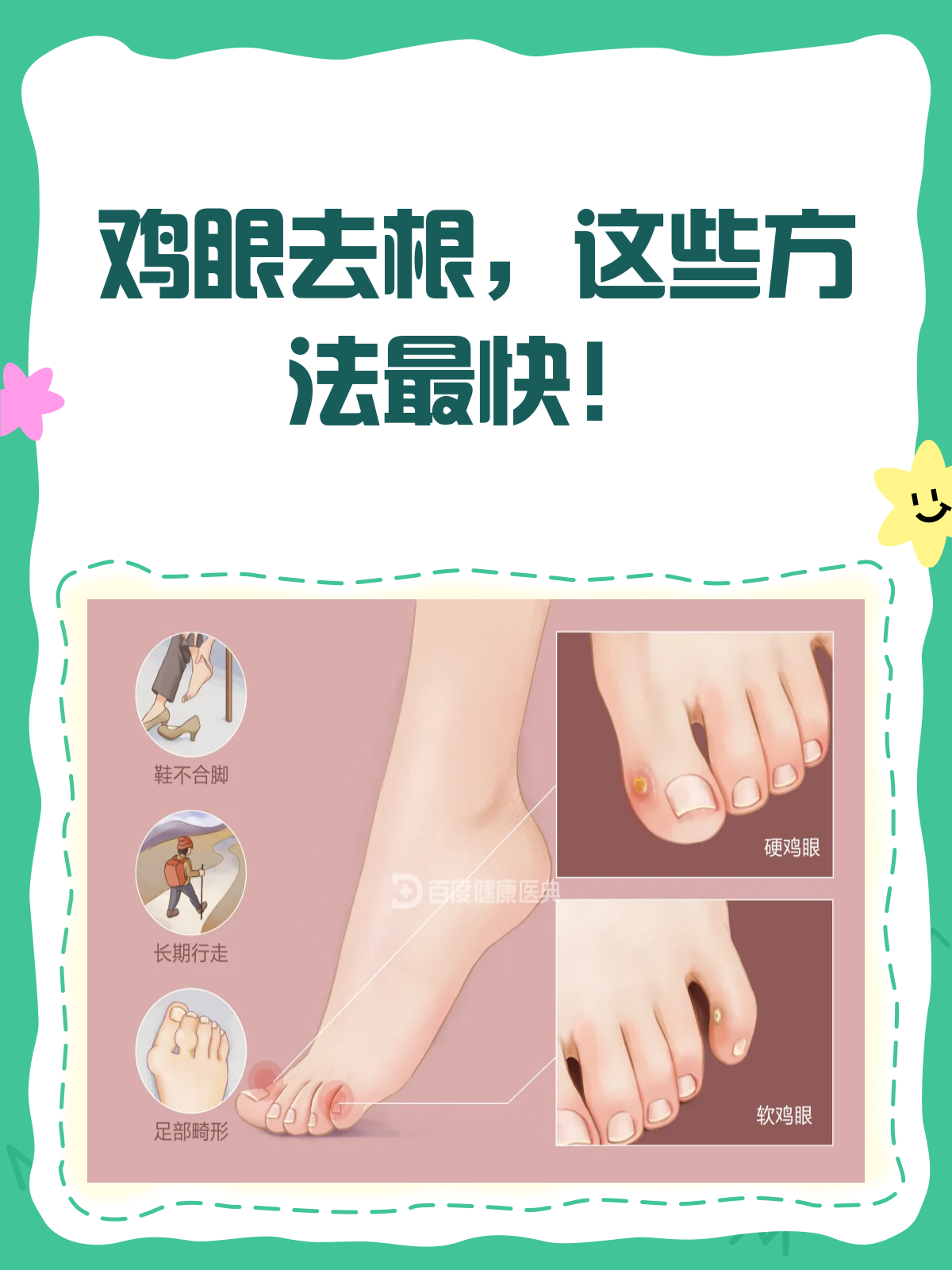 鸡眼去根不再难！这些方法助你快速摆脱