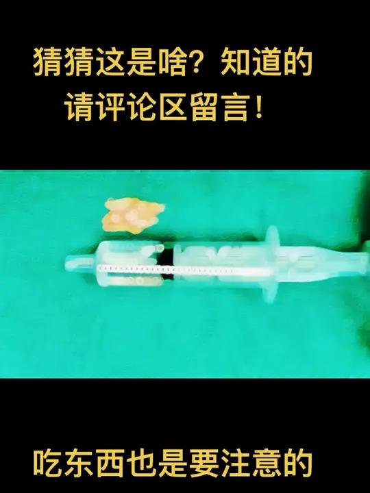 吃东西也需要小心,猜猜这是啥?食管异物是指因饮食不慎,误咽异物,如鱼刺、骨片或脱落的假牙等