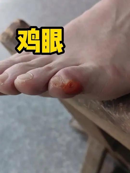 脚趾长鸡眼怎么办?