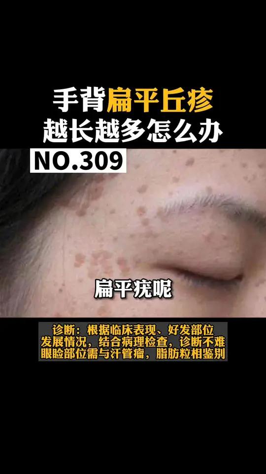 手背,脸上长了扁平丘疹,扁平疣不要抠,会越来越多的