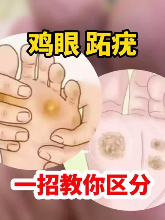 鸡眼 跖疣 一招教你分清