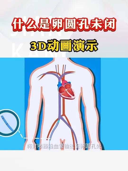 什么是卵圆孔未闭