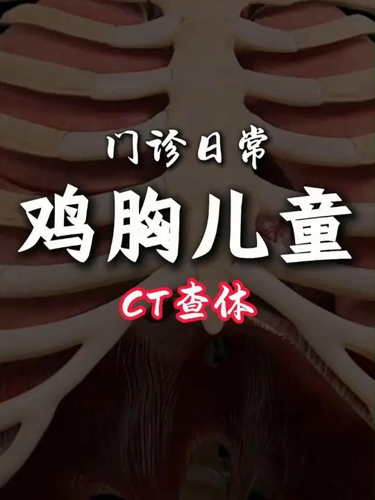胖与鸡胸不同,胖胖的小朋友鸡胸,容易被忽略,如果家长怀疑,建议早做检查。鸡胸 健康科普
