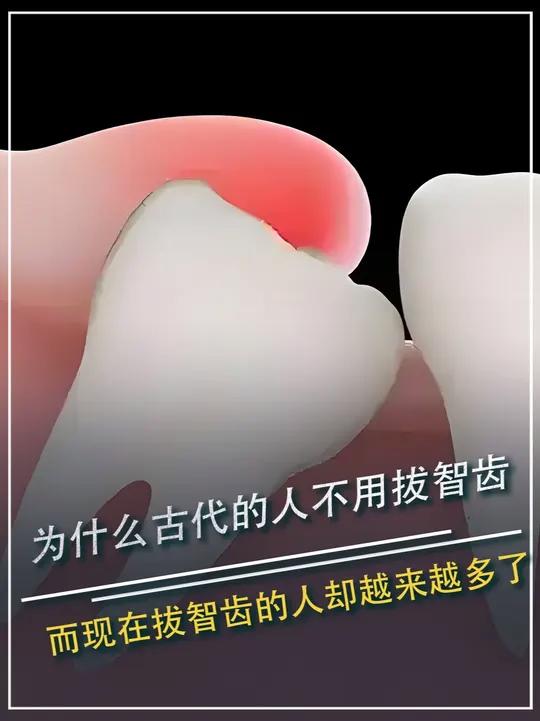 为什么古代的人不用拔智齿,而现在拔智齿的人却越来越多了?